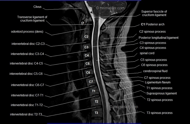 mri cervical spine sagittal cross sectional anatomy 6