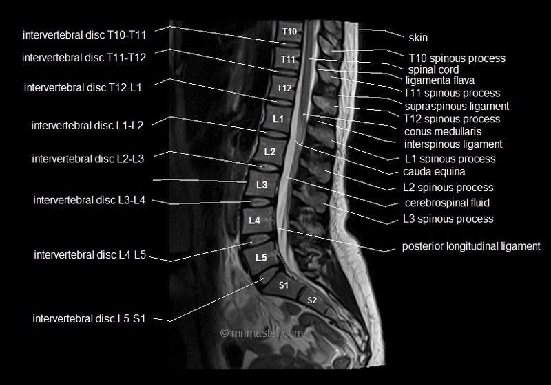 MRI lumbar spine sagittal cross sectional anatomy image 7