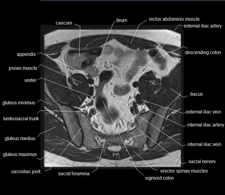 mri axial cross sectional anatomy male pelvis 7