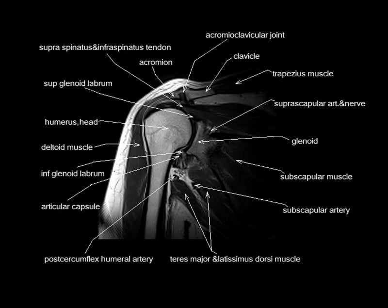 mri shoulder cross sectional anatomy coronal image 7