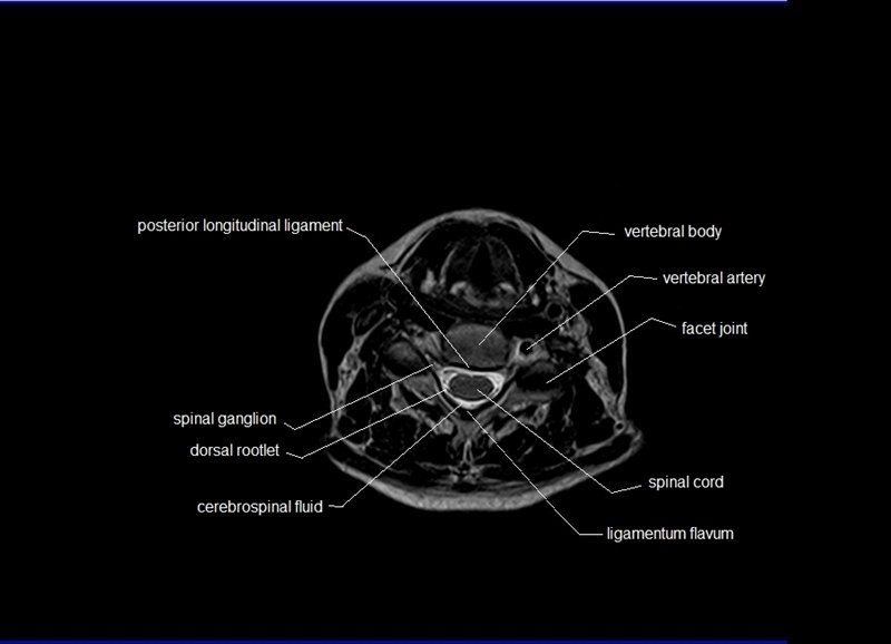 Posterior Neck Muscles Anatomy Radiology Posterior Neck Muscles Anatomy Radiology