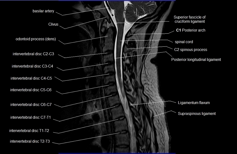 mri cervical spine sagittal cross sectional anatomy image 7