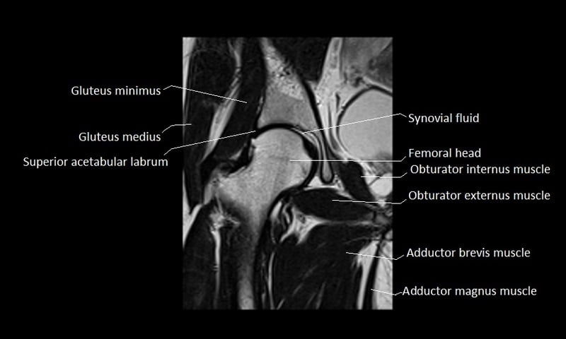 mri coronal cross sectional anatomy hip 8