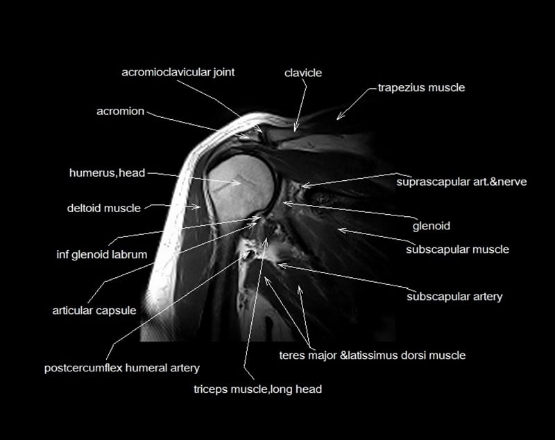 mri shoulder cross sectional anatomy coronal image 8