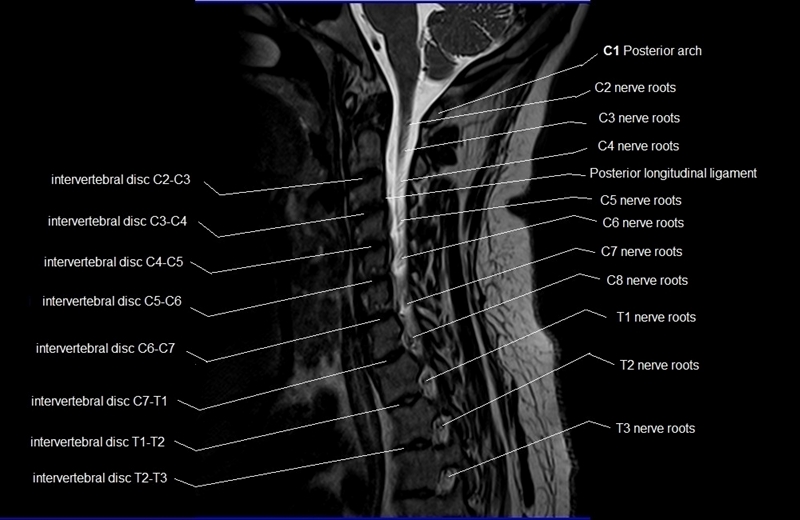 mri cervical spine sagittal cross sectional anatomy image 8