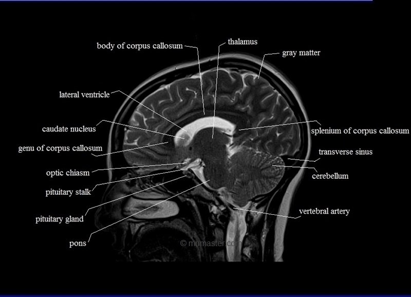 Cross Sectional Anatomy Mri Brain Sagittal Anatomy