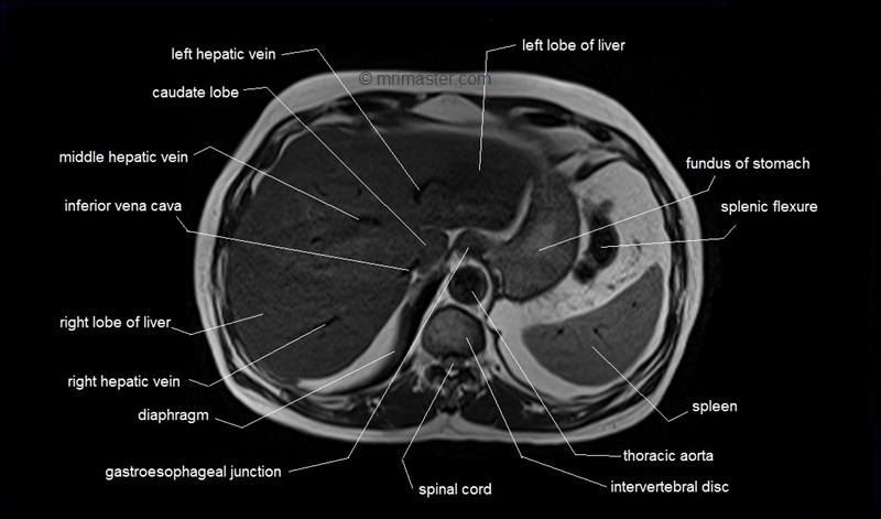 mri axial cross sectional anatomy of abdomen image 9