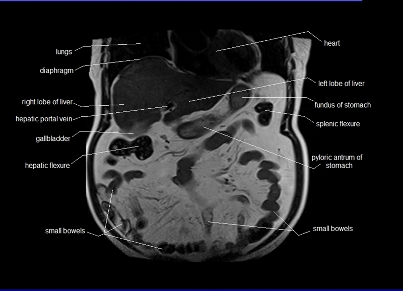mri coronal cross sectional anatomy of abdomen image 9
