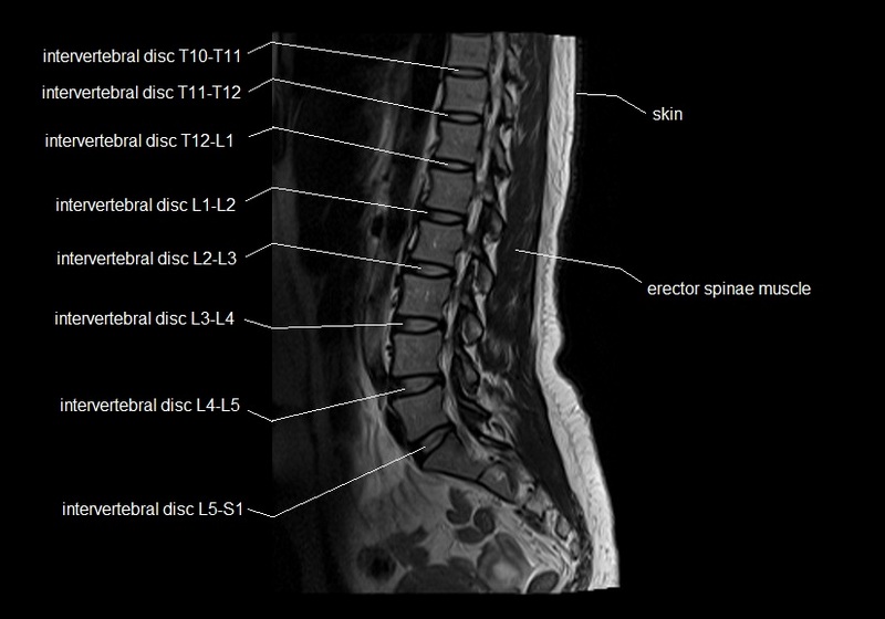 MRI lumbar spine sagittal cross sectional anatomy image 9