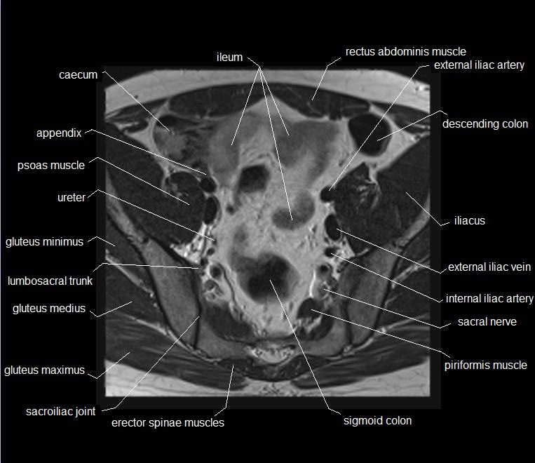 mri axial cross sectional anatomy male pelvis 9