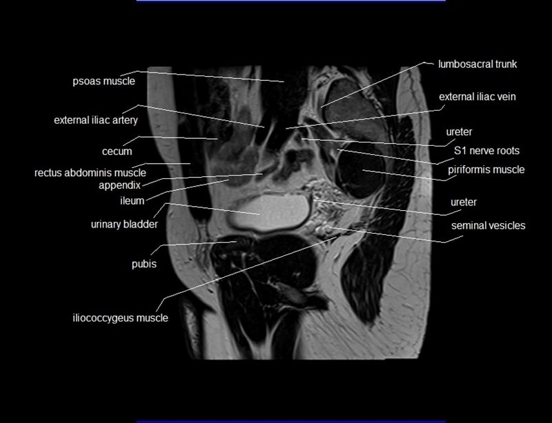 mri sagittal cross sectional anatomy male pelvis image 9