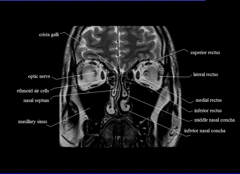 MRI anatomy brain axial image 9