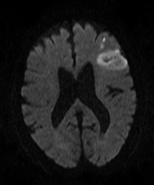 DW 1 - MRI