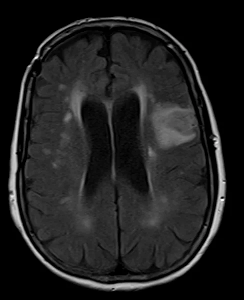 FLAIR - MRI Planning