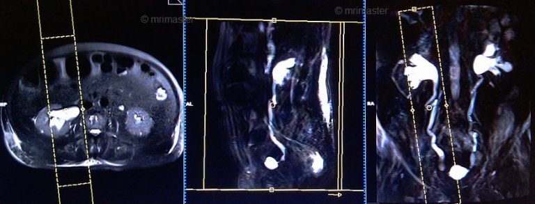 MRI Urography Planning | Urography Protocols | Indications for MRI ...