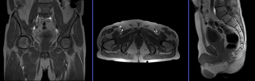 MRI PELVIS LOCALIZER - MRI