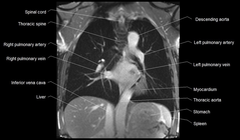 mri cross sectional anatomy chest (thorax) coronal 