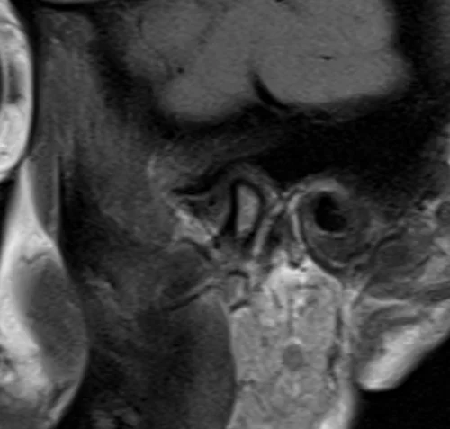 MRI tmj sag PD image 3 z - MRI