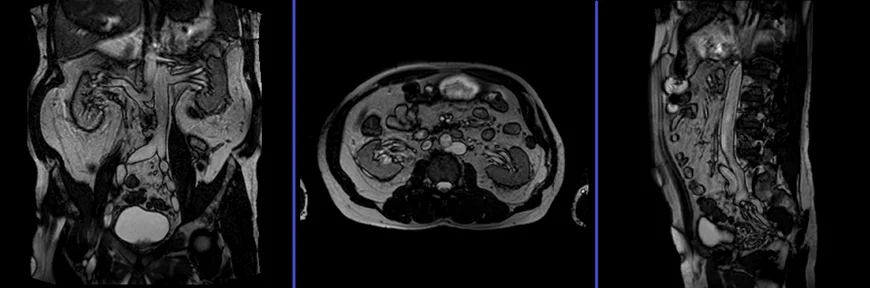 MRV abdomen localizer planning image - MRI