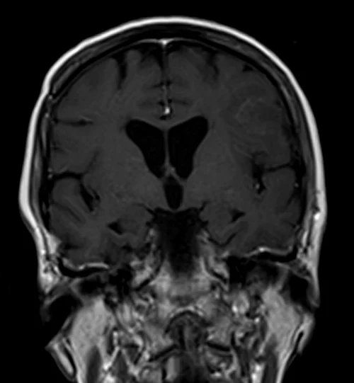 POST COR - MRI