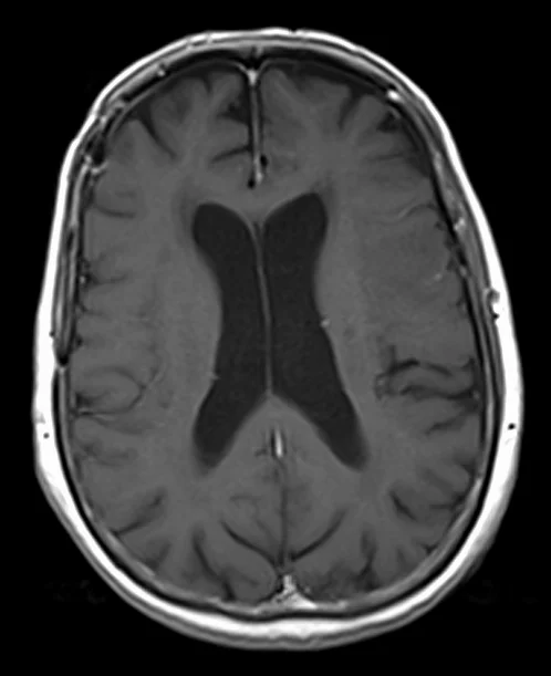 POST T1 - MRI