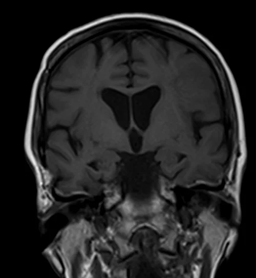 T1 PRE - MRI