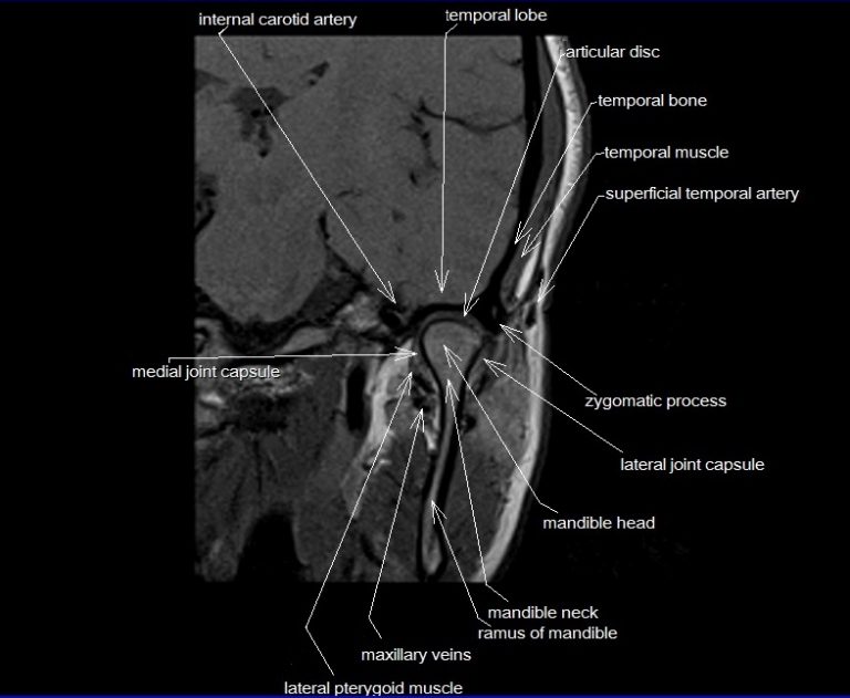 Temporomandibular Joint Anatomy 