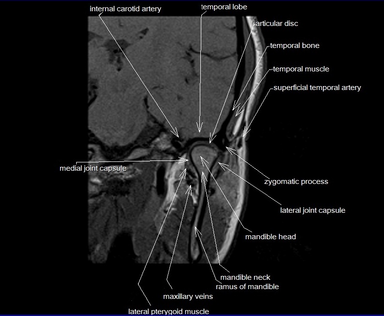 Temporomandibular Joint Anatomy | MRI TMJs Anatomy | Free Sagittal ...