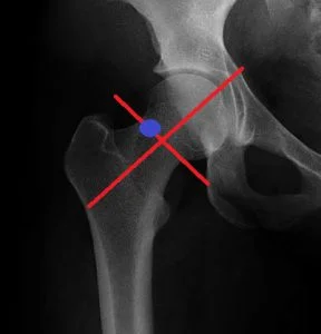 hip arthrography Marking for injection - MRI