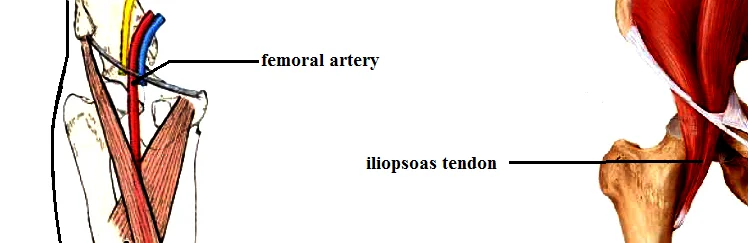 hip arthrography making - MRI