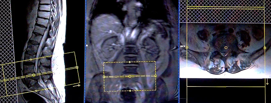 lumbar spine mri planning of axial - MRI