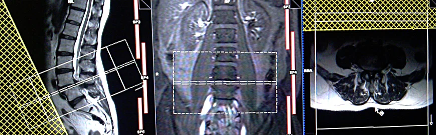 lumber spine MRI planning axial 2 - MRI