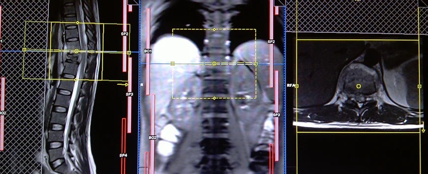 lumber spine MRI planning axial 3 - MRI