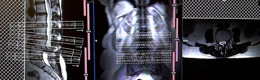 lumber spine MRI planning axial 4 - MRI