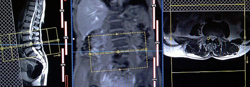 lumber spine MRI planning axial 5 - MRI