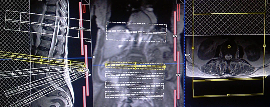 lumber spine MRI planning axial - MRI