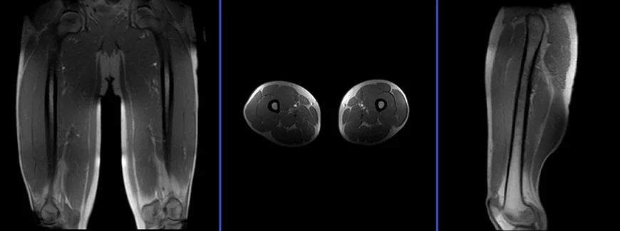 Upper Leg MRI scan  Medserena Open MRI