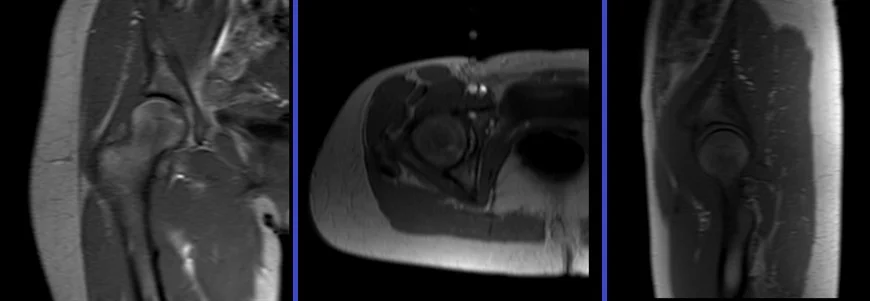 mri arthrogram localizer image - MRI