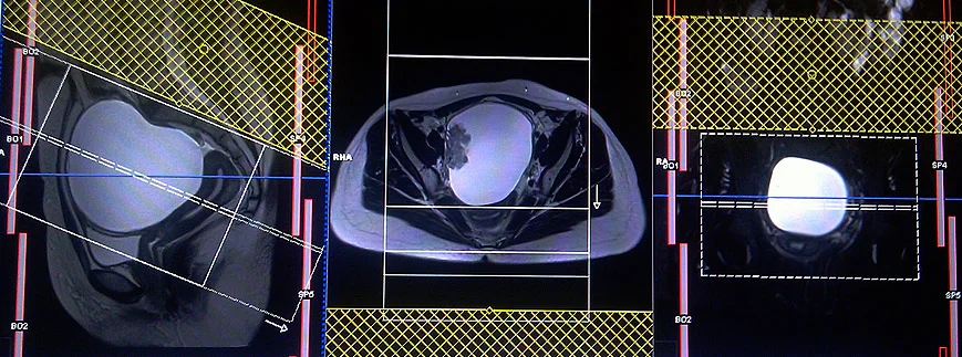 mri axial planning for ovarian cancers 1 - MRI