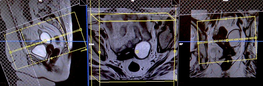 mri axial planning for ovarian cancers 4 - MRI