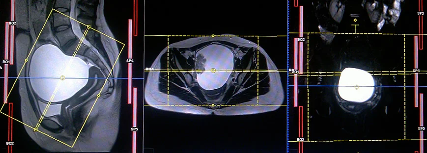mri coronal planning for ovarian cancers 2 - MRI