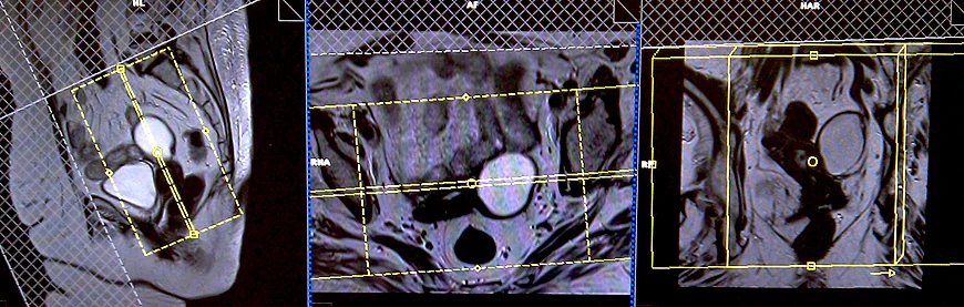 mri coronal planning for ovarian cancers 5 - MRI