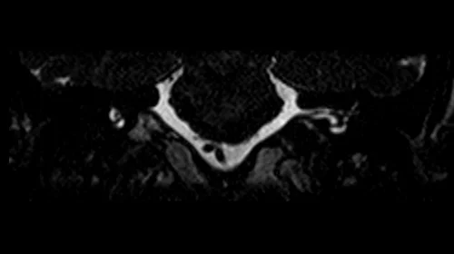 mri iam’s ciss mri coronal image 1 - MRI