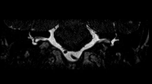 mri iam’s ciss mri coronal image 2 - MRI