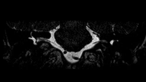 mri iam’s ciss mri coronal image 3 - MRI