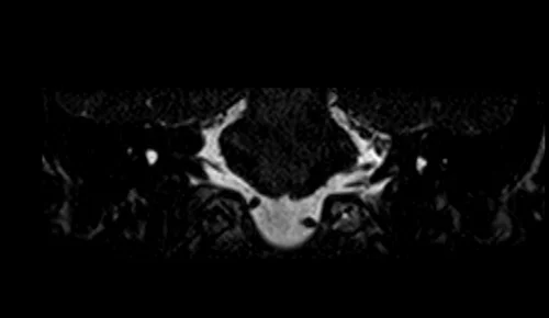 mri iam’s ciss mri coronal image 4 - MRI