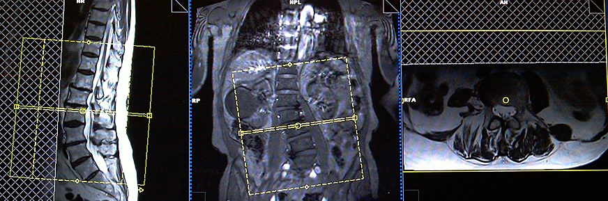 mri lumbar spine axial planning in scoliosis patient - MRI