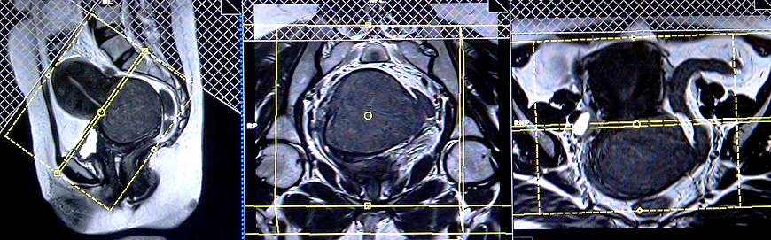 mri planning for ca cervix axial scans 2 - MRI