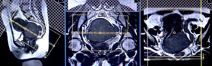 mri planning for ca cervix coronal scans - MRI