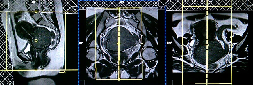 mri planning for ca cervix sagittal scans 3 - MRI